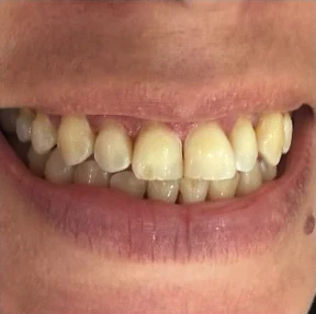 Antes — Diseño de sonrisa en Medellín
