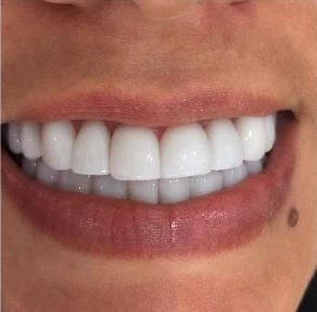 Después — Diseño de sonrisa en Medellín