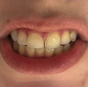 Antes — Diseño de sonrisa en Medellín, antes y después — caso 2