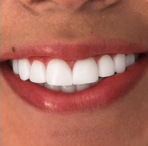 Después — Diseño de sonrisa en Medellín, antes y después — caso 2
