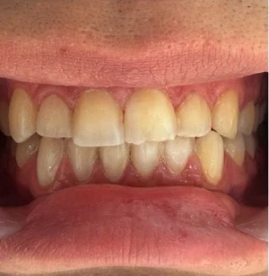 Antes — Diseño de sonrisa en Medellín, antes y después — caso 3