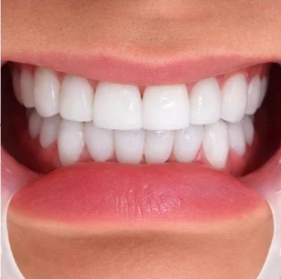 Después — Diseño de sonrisa en Medellín, antes y después — caso 3