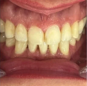 Antes — Diseño de sonrisa en Medellín, antes y después — caso 4