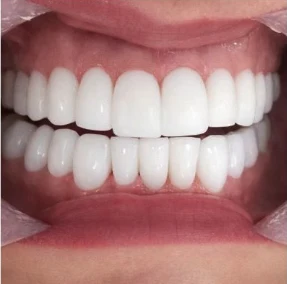 Después — Diseño de sonrisa en Medellín, antes y después — caso 4