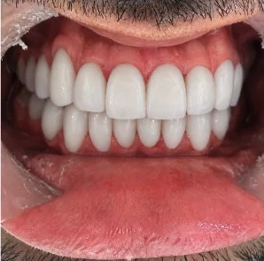 Después — Diseño de sonrisa en Medellín, antes y después — caso 5