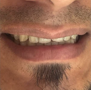 Antes — Diseño de sonrisa en Medellín, antes y después — caso 6