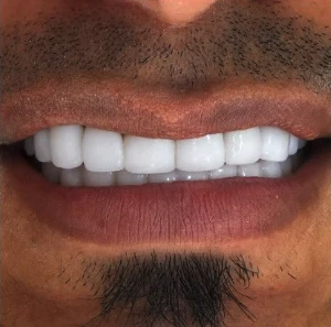 Después — Diseño de sonrisa en Medellín, antes y después — caso 6