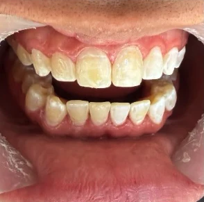 Antes — Diseño de sonrisa en Medellín, antes y después — caso 7
