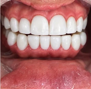 Después — Diseño de sonrisa en Medellín, antes y después — caso 7