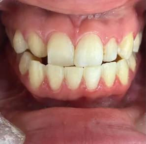 Antes — Diseño de sonrisa en Medellín, antes y después — caso 8