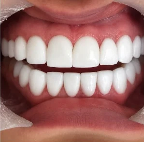 Después — Diseño de sonrisa en Medellín, antes y después — caso 8